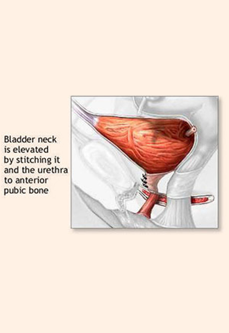 Female Urogyneacology