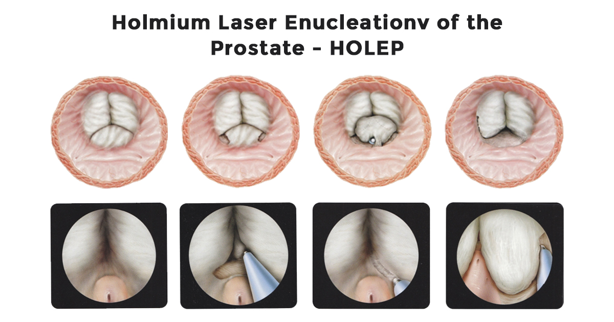HOLEP