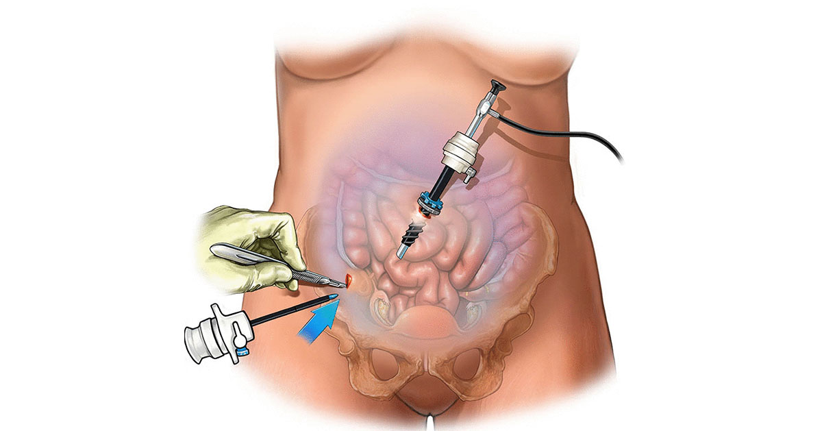Laparoscopy