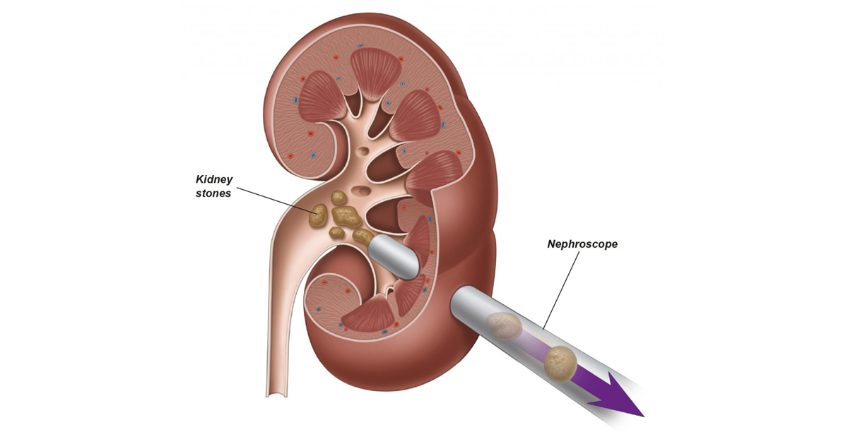 PCNL Treatment