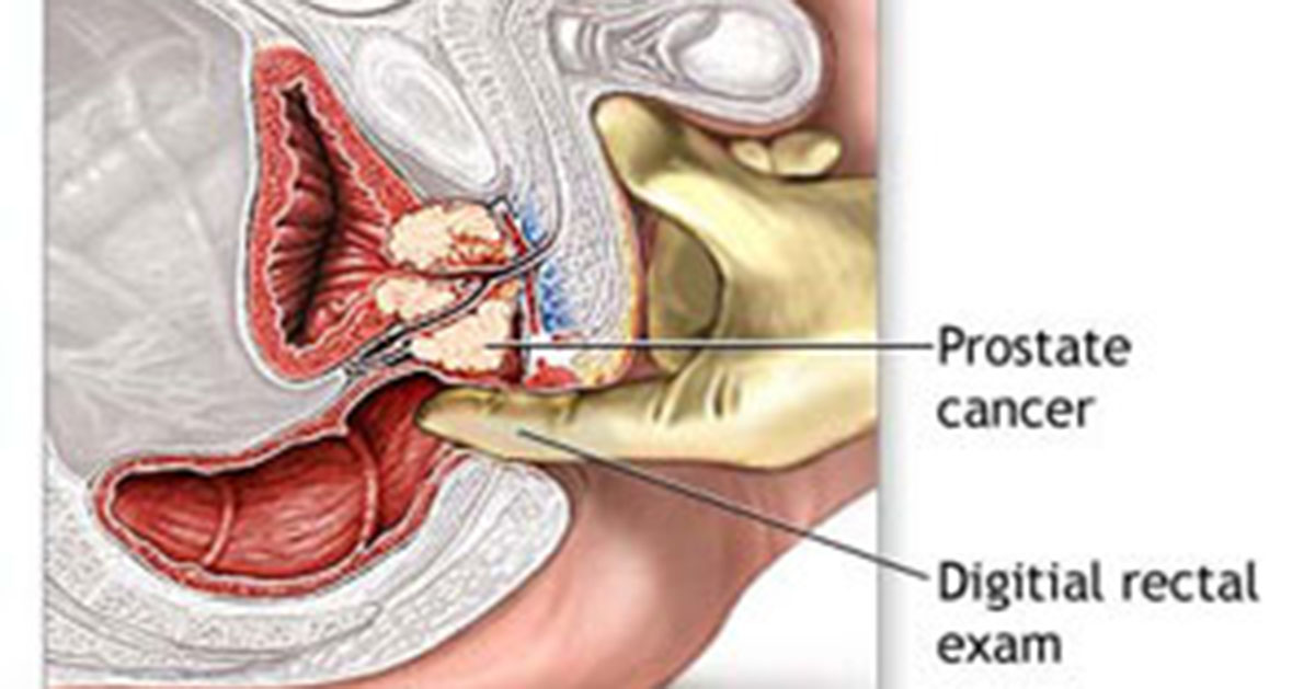 Prostate Cancer