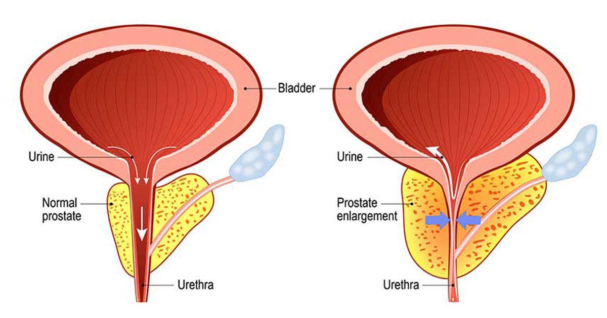 Prostate BPH