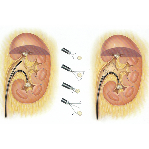 Stone in kidney