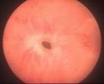 Stricture Urethra
