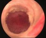 Stricture Urethra