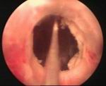 Stricture Urethra