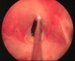 Stricture Urethra