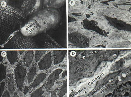 Stricture Urethra