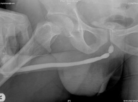 Stricture Urethra