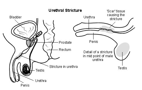 Stricture Urethra