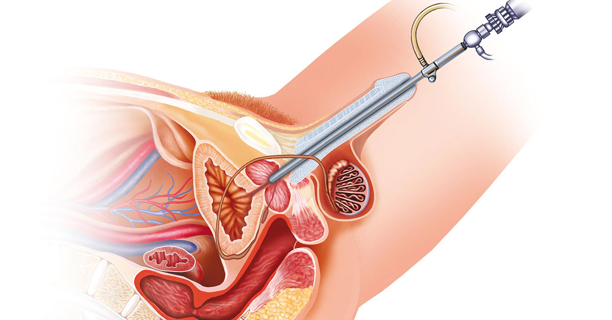 Stricture Urethra