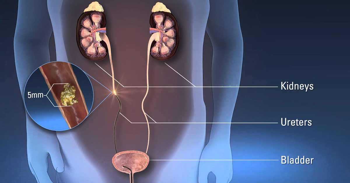 Ureteroscopy (URS)